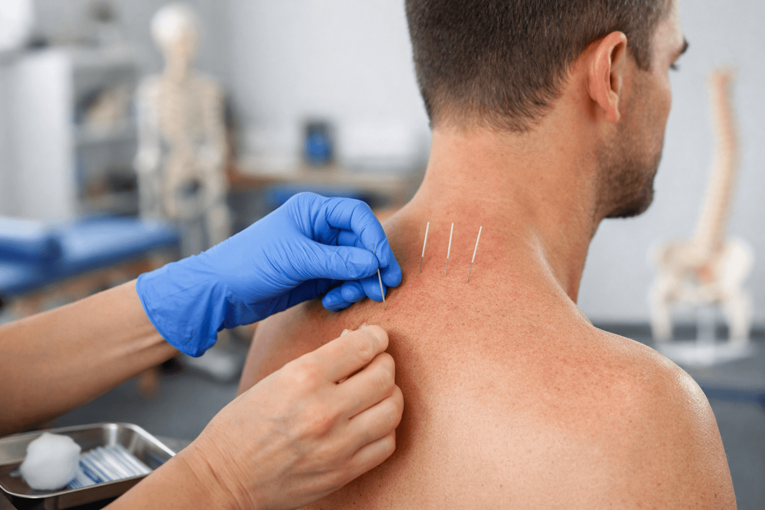 Acupuncture & Dry Needling physiotherapy service Port Credit Mississauga